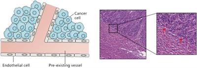 Vessel co-option: a unique vascular-immune niche in liver cancer